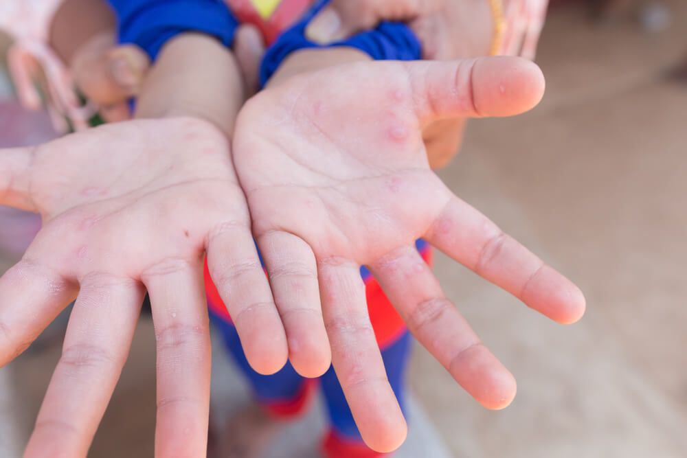 Enterovirus Symptoms and Prevention in Children